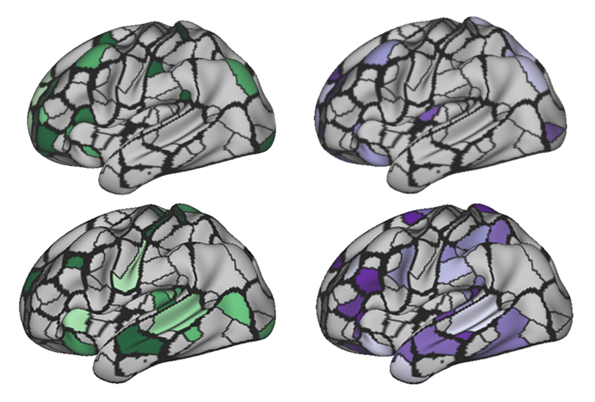 Four 3D brains showing areas highlighted in green and purple.