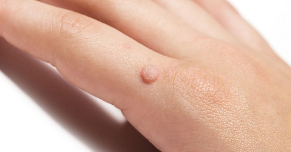 Treatment of Warts with Hypnosis